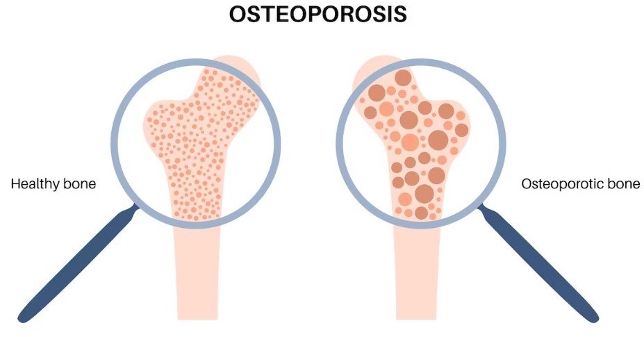 Connection Between BMI, DEXA Test & Bone Density 2 bone 1