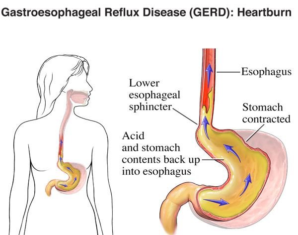 Does GERD Cause Weight Gain