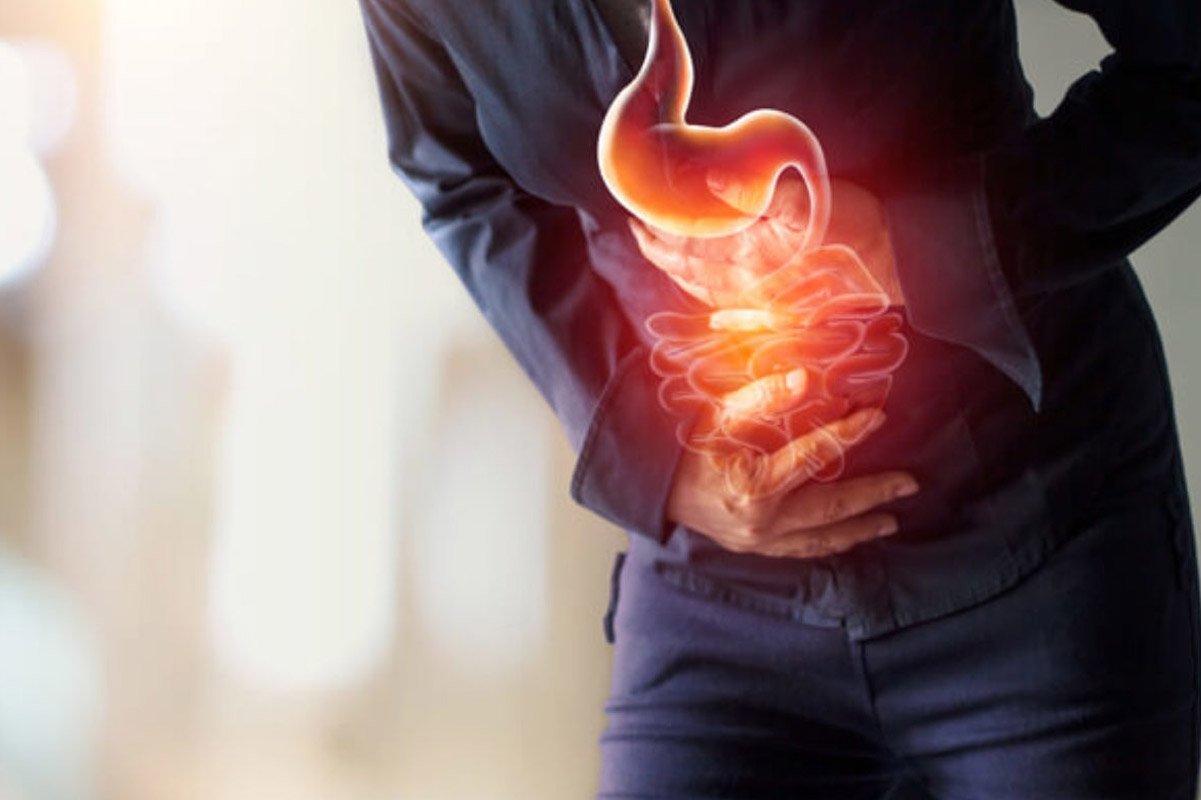 What is Acid reflux and GERD
