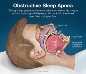 sleep apnea bmi
