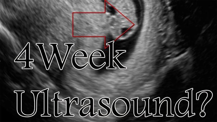 4 Weeks Pregnant Ultrasound: See Early Signs of New Life 1 4 weeks ultrasound ✔️What Can You Expect to See