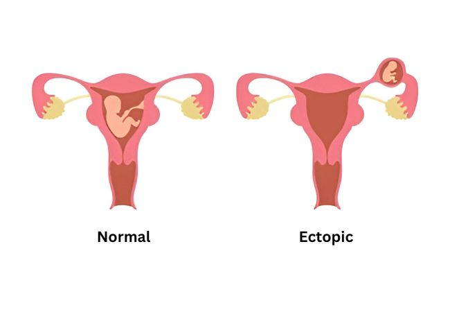 Ectopic Pregnancy Help & Care in Florida 1 image