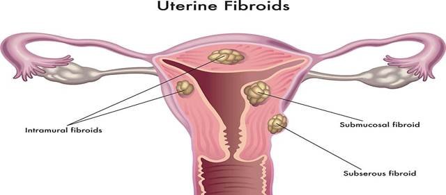 Fibroids Cause Weight Gain